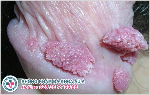 sùi mào gà ở nam giới