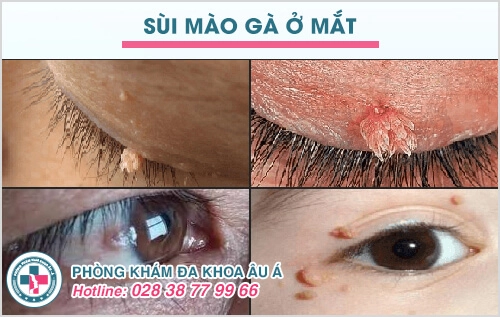 sùi mào gà ở nam giới
