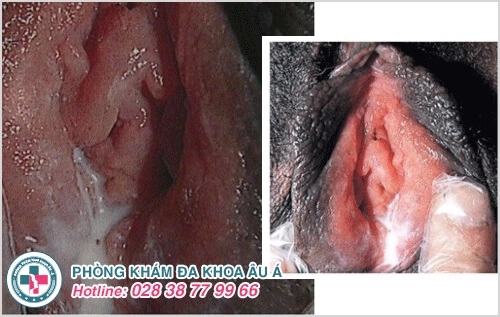 hội chứng tiết dịch niệu đạo