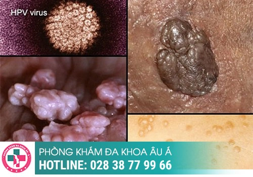 Mụn cóc ở vùng kín là bệnh gì?