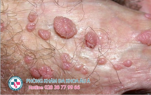 mụn cóc sinh dục