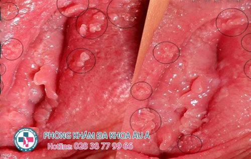 mụn cóc sinh dục