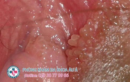 mụn cóc sinh dục