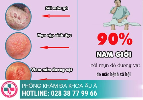 Nổi Mụn Trắng Ở Bộ Phận Sinh Dục Nam Giới