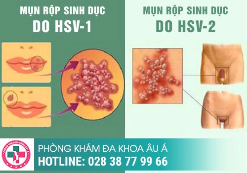Mọc mụn ở quanh rãnh bao quy đầu là bệnh gì?