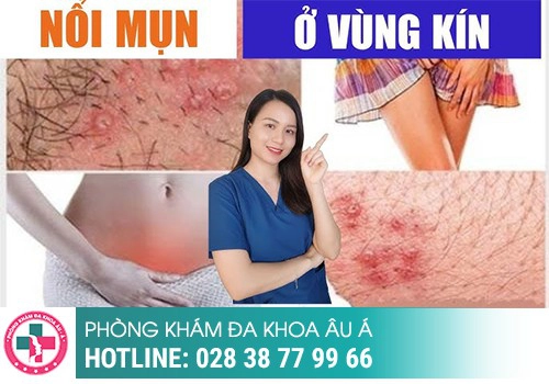 Nguyên nhân nổi mụn nước ở vùng kín