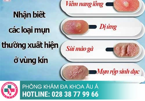 Hiện tượng mọc mụn thịt ở môi lớn môi bé là dấu hiệu bệnh gì?