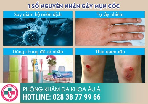 Nguyên nhân gây nổi mụn cóc ở vùng kín