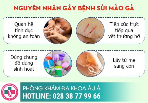  Sùi mào gà có lây hay không?