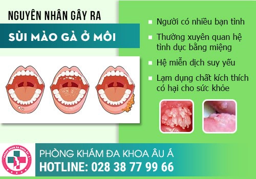 Nguyên nhân bị sùi mào gà ở môi là gì?