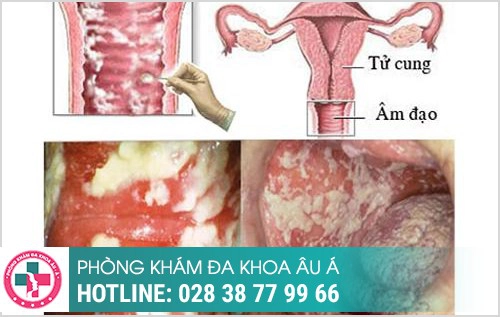 nỗi hạch ở vùng kín nữ có sao không