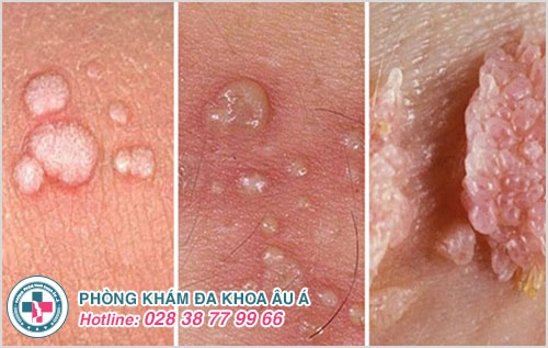 Nguyên Nhân Nổi Mụn Bộ Phận Sinh Dục Nam