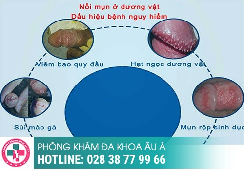 Nổi mụn thịt ở bìu tinh hoàn là dấu hiệu bệnh gì? 