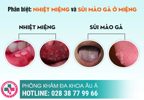 Mọc mụn thịt ở cuống lưỡi là bệnh gì?