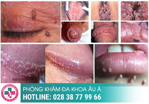 Khi nào cần xét nghiệm sùi mào gà?