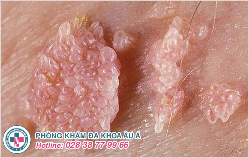 đốt sùi mào gà có trị sùi mào gà được không