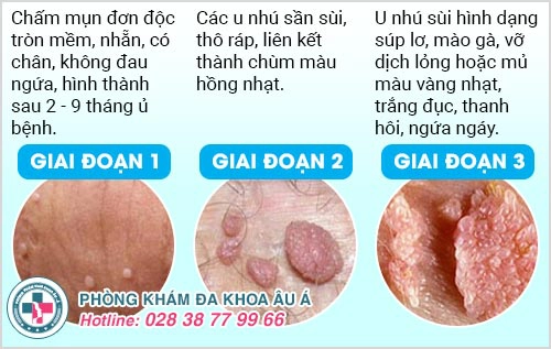 địa chỉ chữa sùi mào gà