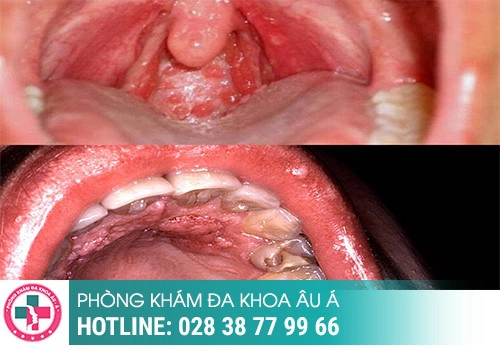 Hình ảnh sùi mào gà ở môi giai đoạn đầu