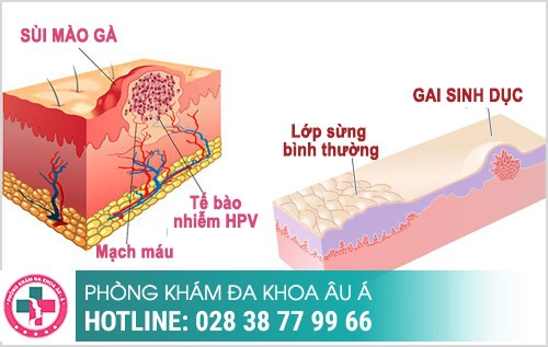 Nhận biết sùi mào gà và gai sinh dục