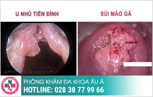 Nhận biết sùi mào gà và gai sinh dục