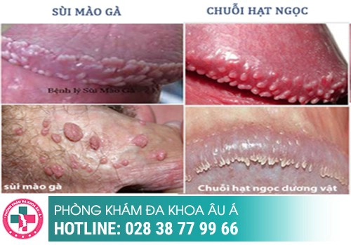 Hình ảnh hạt ngọc dương vật