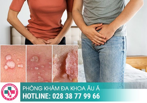   Xét nghiệm sùi mào gà bằng phương pháp type HPV - PCR