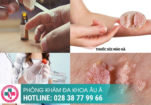 hình ảnh gai sinh dục