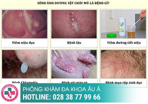 Tiểu ra dịch – Coi chừng mắc bệnh lậu