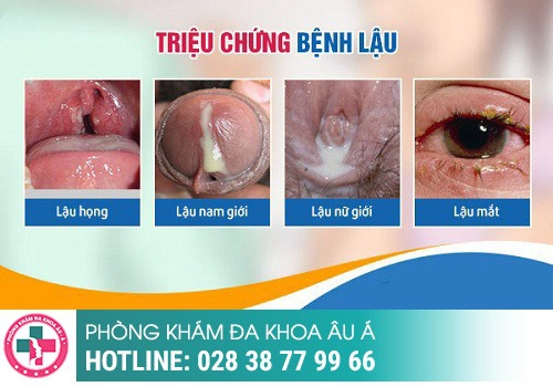 dấu hiệu bệnh lậu ở nam giới