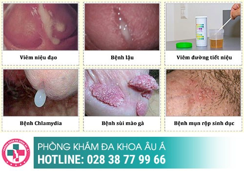 4 nguyên nhân khiến cậu nhỏ chảy mủ bạn cần biết