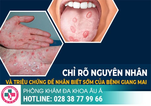 Giang mai ở miệng