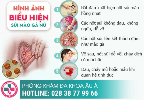 Sùi mào gà ở nữ là bệnh gì?
