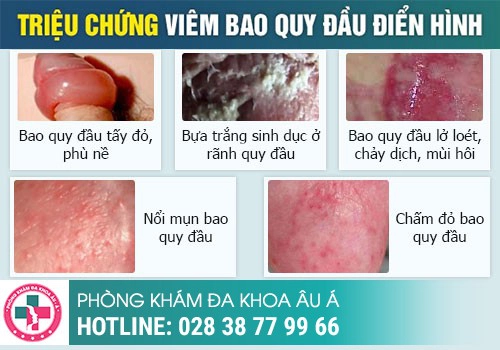 Chảy mủ niệu đạo có phải mắc bệnh lậu không?