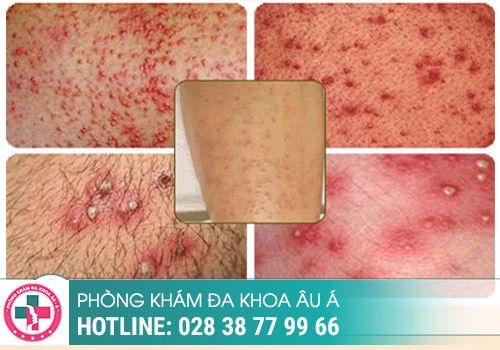 Nổi mụn ngứa ở vùng kín nữ nguyên nhân do đâu?