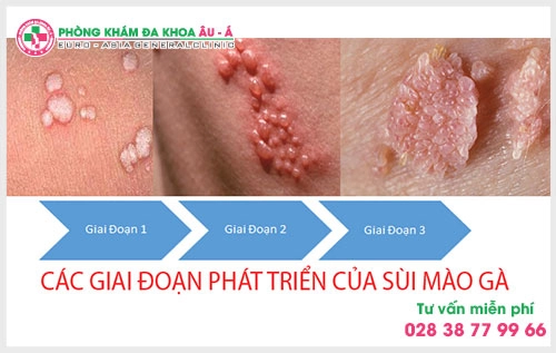 Bệnh sùi mào gà khám ở khoa nào là tốt  tại TPHCM? Đây chính là thắc mắc của rất nhiều người bệnh trong số đó có bạn Nhật Nam đã gởi tâm sự của mình về chuyên mục tư vấn bệnh xã hội tại phòng khám Đa Khoa Âu Á.