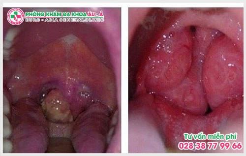 Theo những thống kê gần đây cứ 10 ca điều trị về bệnh xã hội lại có 6 ca liên quan đến bệnh sùi mào gà. Vậy biểu hiện của bệnh sùi mào gà ở cổ họng như thế nào? 