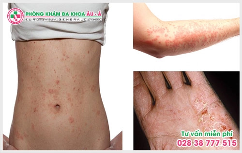 Chính vì thế bài viết dưới đây sẽ giúp người bệnh có thể hiểu rõ hơn về bệnh chàm cơ địa và từ đó có cách điều trị tốt hơn.