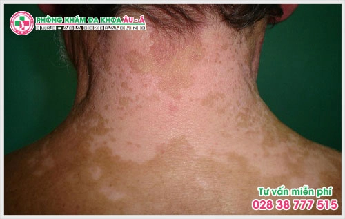 Bệnh bạch biến có nguy hiểm không?