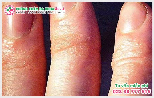 Để biết cách trị bệnh chàm đầu chi nào hiệu quả bệnh nhân nên tìm đến các bác sĩ thăm khám trực tiếp từ đó mới đưa ra phương hướng điều trị phù hợp.