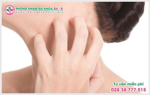 Bên cạnh điều trị bằng tây y thì có thể chữa bệnh bằng đông y, các loại thảo dược thiên nhiên này có tác dụng giảm ngứa bệnh chàm.