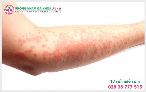 Bên cạnh điều trị bằng tây y thì có thể chữa bệnh bằng đông y, các loại thảo dược thiên nhiên này có tác dụng giảm ngứa bệnh chàm.