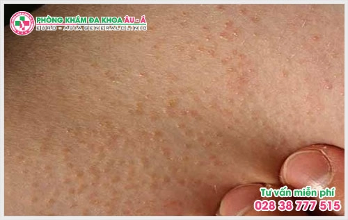 Bệnh dày sừng nang lông có chữa được không?