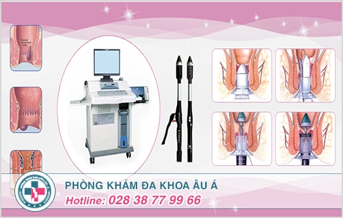 Bệnh trĩ ngoại và làm sao để hết bệnh trĩ ngoại?