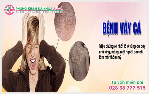 Bệnh vẩy da cá và cách điều trị hiệu quả