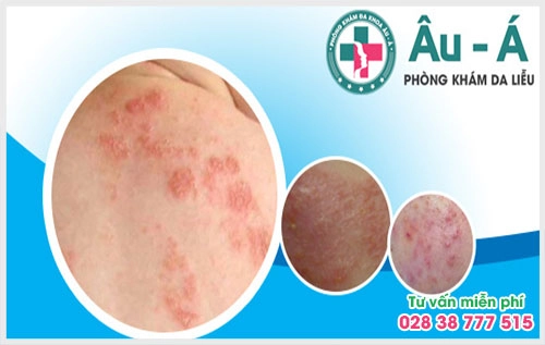 Bệnh vẩy da cá và cách điều trị hiệu quả