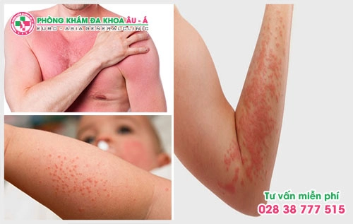 để tìm một bệnh viện bệnh ngứa ở sài gòn uy tín, chất lượng là điều mà rất nhiều người bệnh quan tâm.