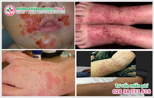 Vì thế, việc tìm một bệnh viện viêm da TPHCM nằm ở đâu? Thì đây chính là mối quan tâm  của rất nhiều người bệnh.