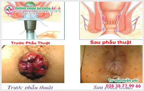 Cách chữa bệnh trĩ bàng dầu dừa đang là một trong những bài thuốc được rất nhiều bệnh nhân áp dụng và chia sẻ nhưng thực hư cách chữa bệnh trĩ bằng dầu dừa là như thế nào?