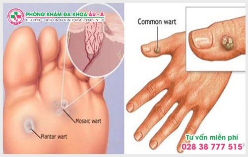 Cách trị mụn cóc hiệu quả  tại TPHCM