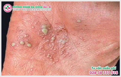 Vẩy nến có mủ chia lại hai loại vảy nến mụn mủ toàn thân và vảy nến mụn mủ lòng bàn tay bàn bàn chân.